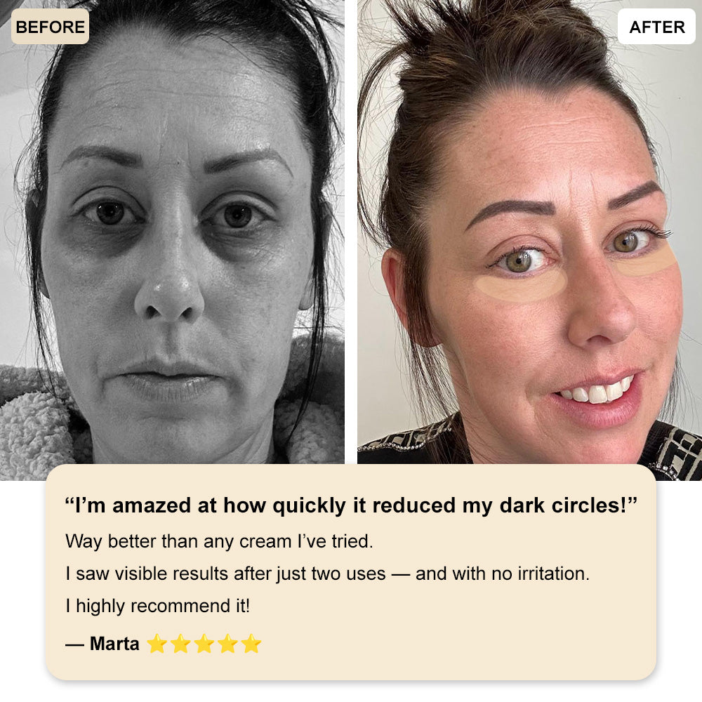 Zvoevo®💫 Deep Precision Age-Defying Nano Microneedle Patches - Deep-acting solution for tackling under-eye bags, dark circles, laughter lines, forehead lines, and all those other pesky facial wrinkles.