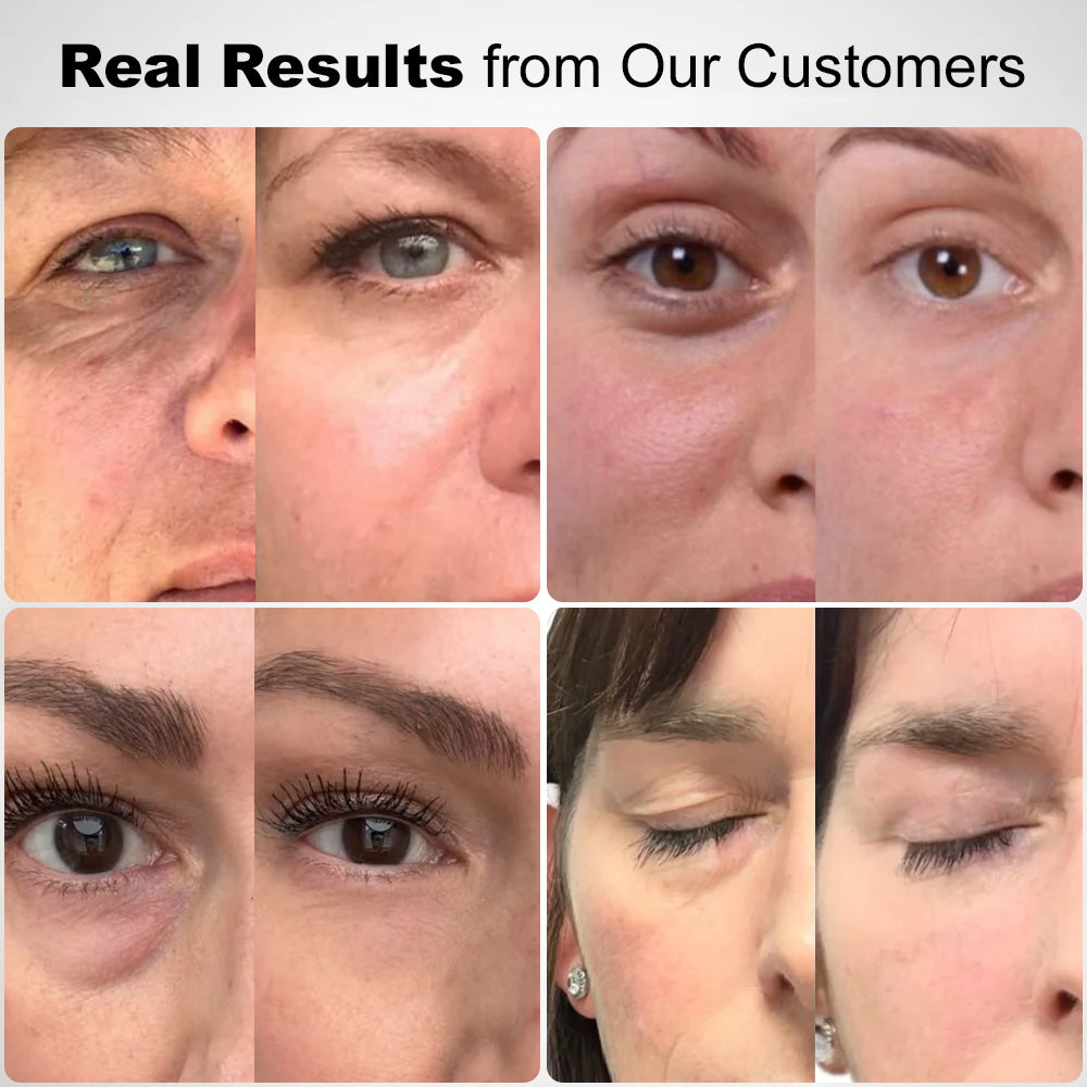 Zvoevo®💫 Deep Precision Age-Defying Nano Microneedle Patches - Deep-acting solution for tackling under-eye bags, dark circles, laughter lines, forehead lines, and all those other pesky facial wrinkles.