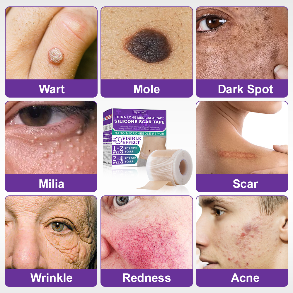 💝 Official Store: Flysmus® ReGen Hyaluronic Acid Nano-Heal Microneedle Tape - 🏷️Treatment of old and new scars, reduction of surgical scars, stretch marks, keloids, acne, burns, warts, dermatomes and varicose veins