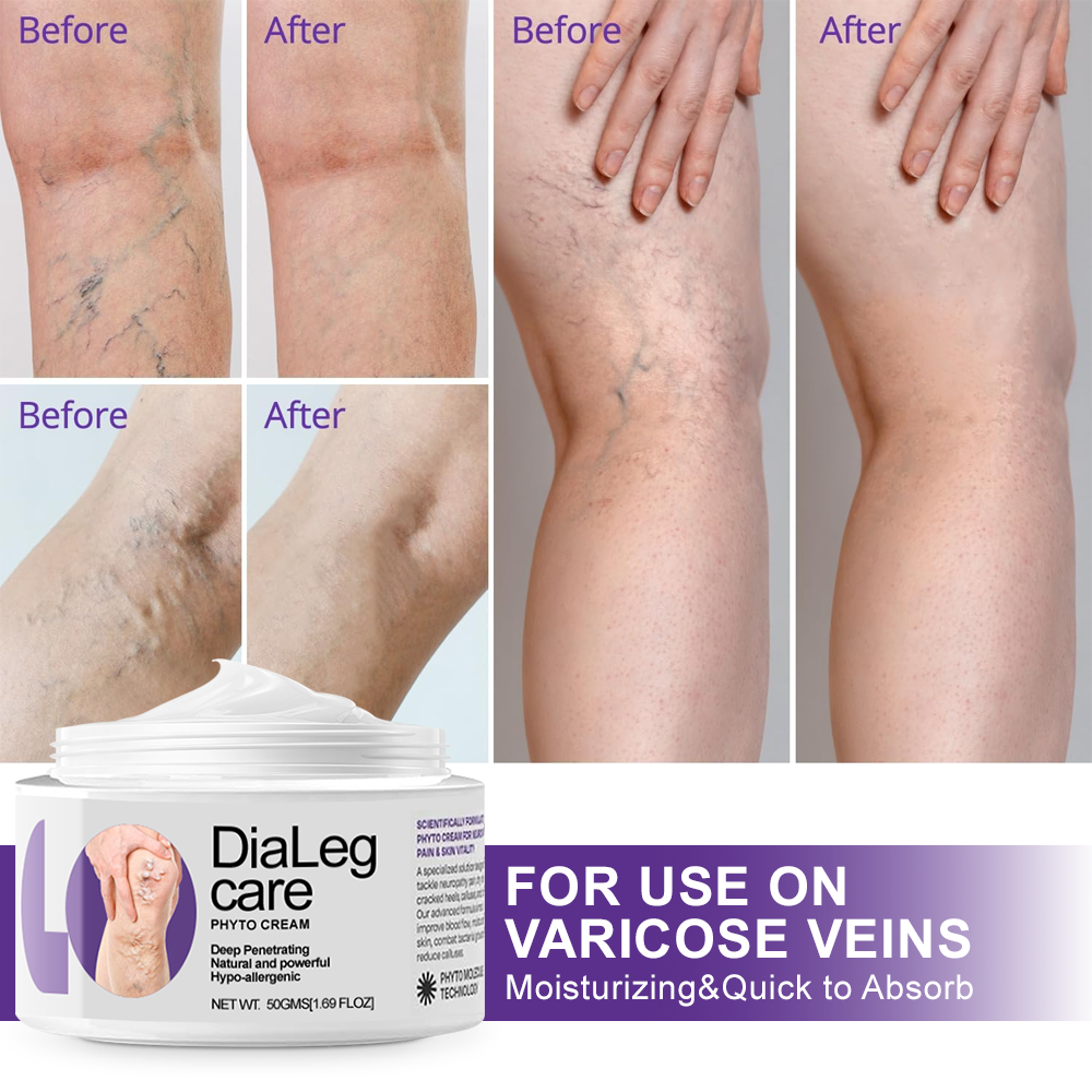 ✅🏆𝐎𝐮𝐫𝐥𝐲𝐚𝐫𝐝®𝐃𝐢𝐚𝐋𝐞𝐠 𝐂𝐚𝐫𝐞 𝐏𝐡𝐲𝐭𝐨 𝐂𝐫𝐞𝐚𝐦 - Helps Treat Varicose Veins, Swelling, Cramps, and Leg Pain